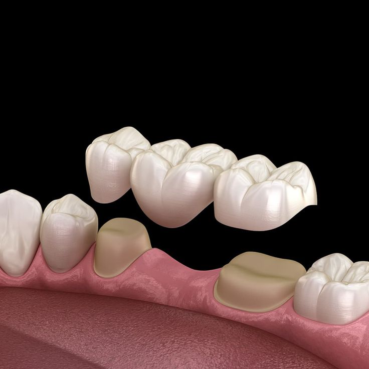 Finished dental crown